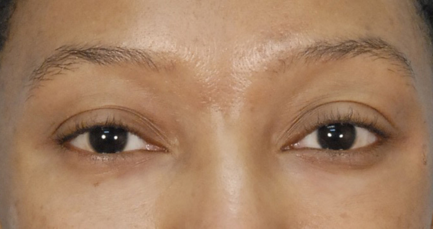 under eye bag removal blepharoplasty