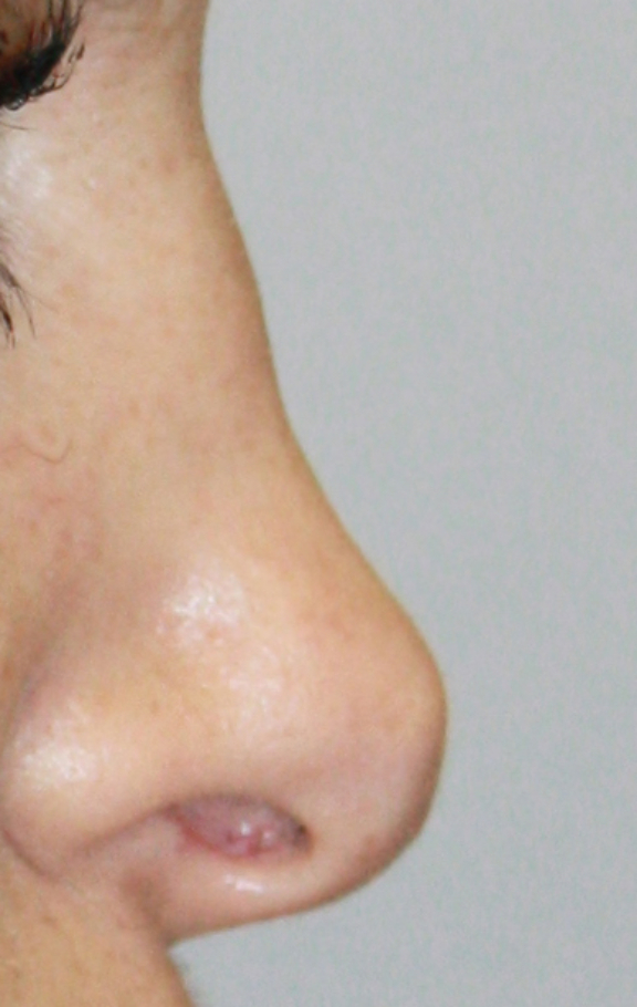 BEFORE NON-SURGICAL RHINOPLASTY