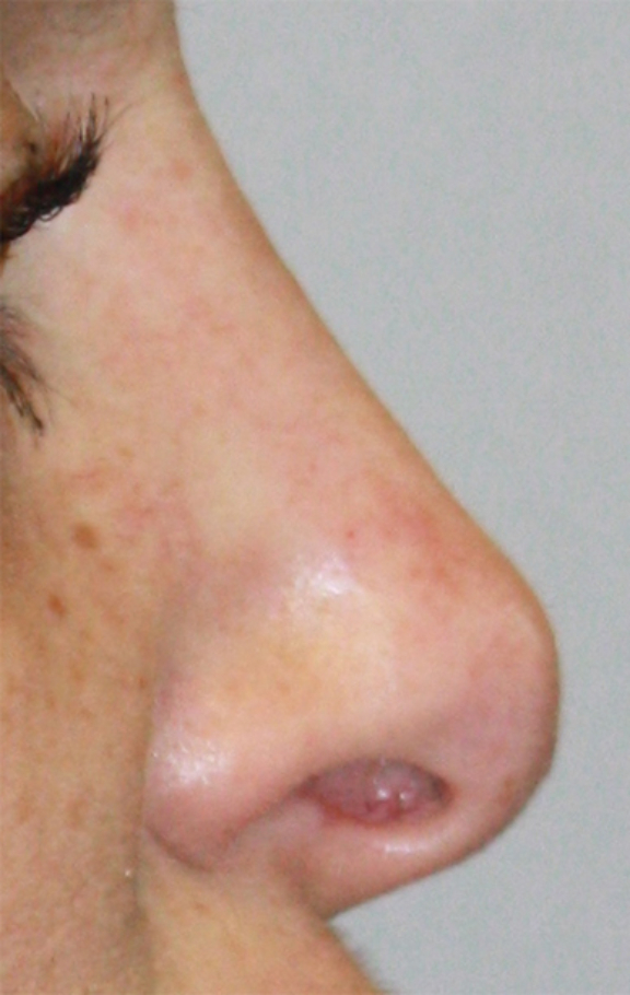 AFTER NON-SURGICAL RHINOPLASTY