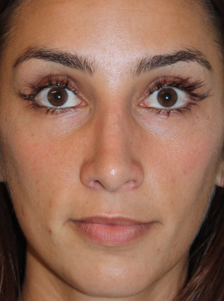 AFTER PRIMARY OPEN RHINOPLASTY
