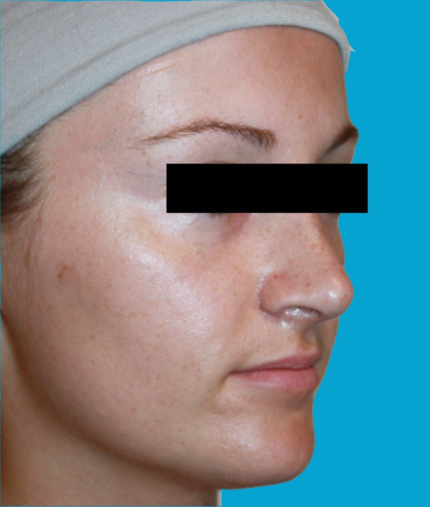 AFTER PRIMARY OPEN RHINOPLASTY