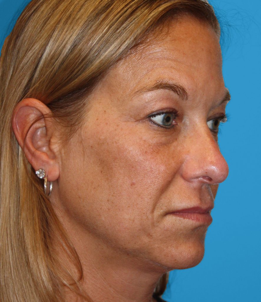 BEFORE REVISION OPEN RHINOPLASTY WITH EAR CARTILAGE GRAFTING