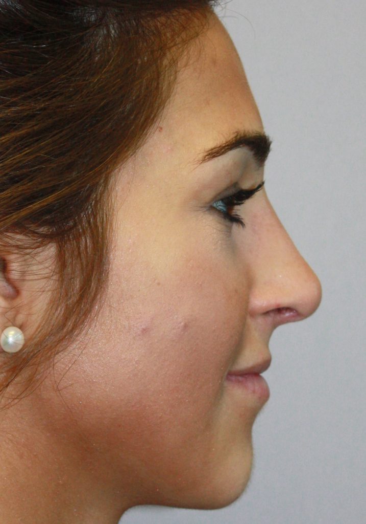 AFTER REVISION RHINOPLASTY