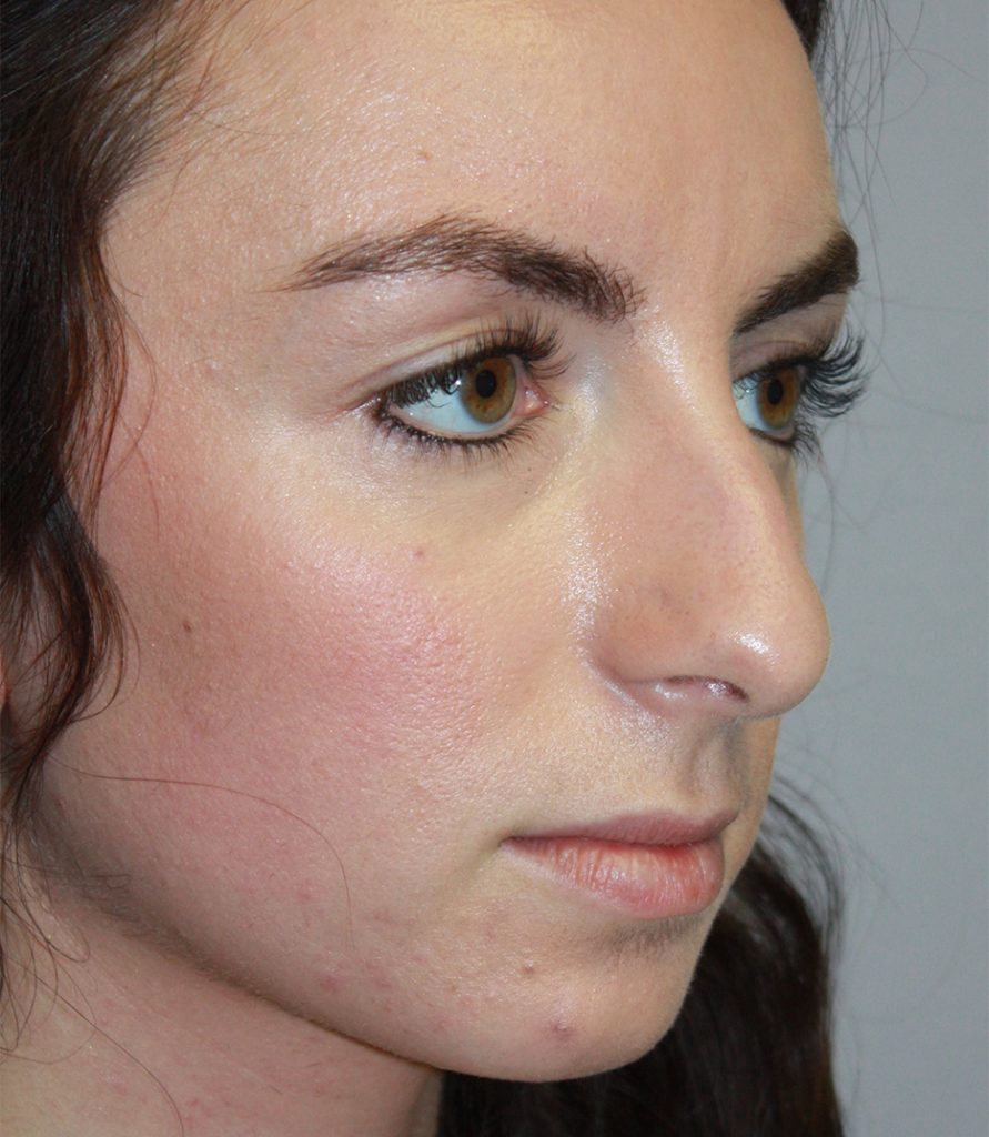 BEFORE STRUCTURAL RHINOPLASTY
