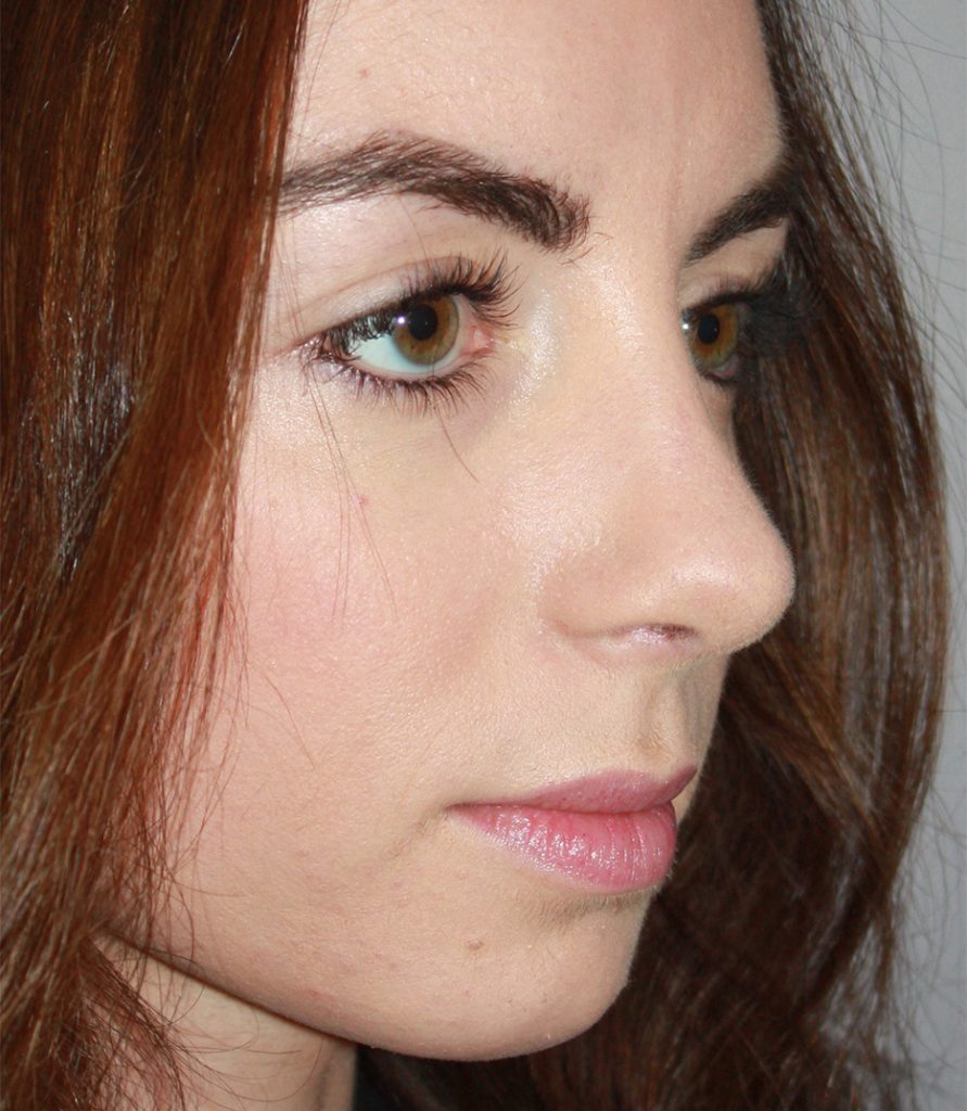AFTER STRUCTURAL RHINOPLASTY