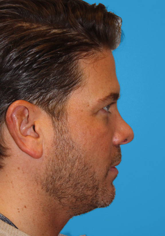 BEFORE OPEN REVISION RHINOPLASTY