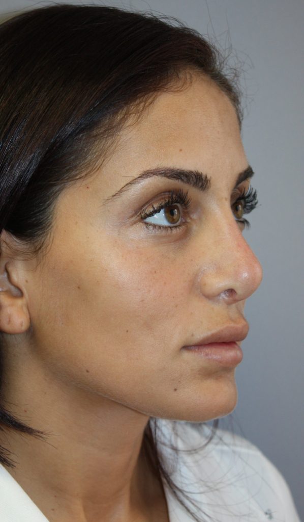 AFTER REVISION RHINOPLASTY