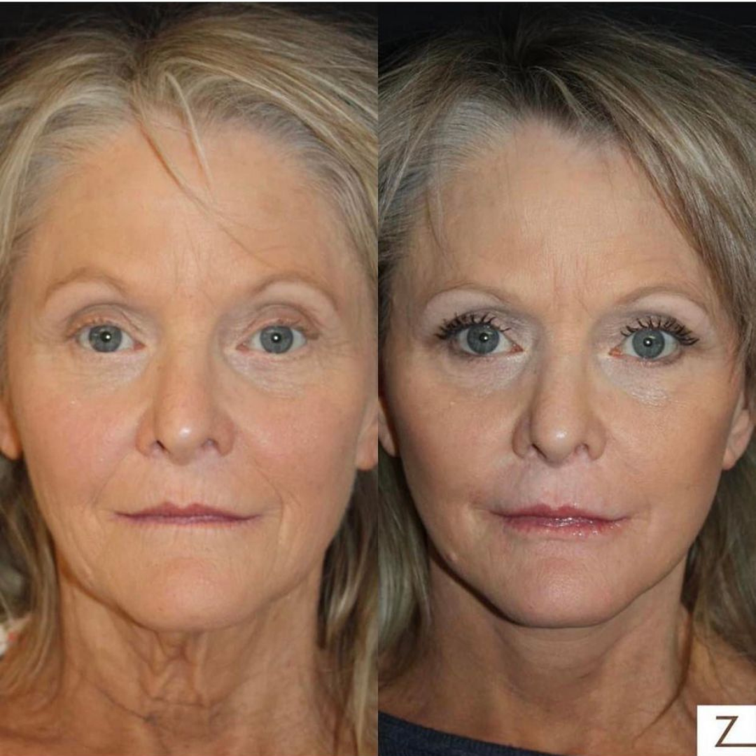 Patient 78 Marge Image