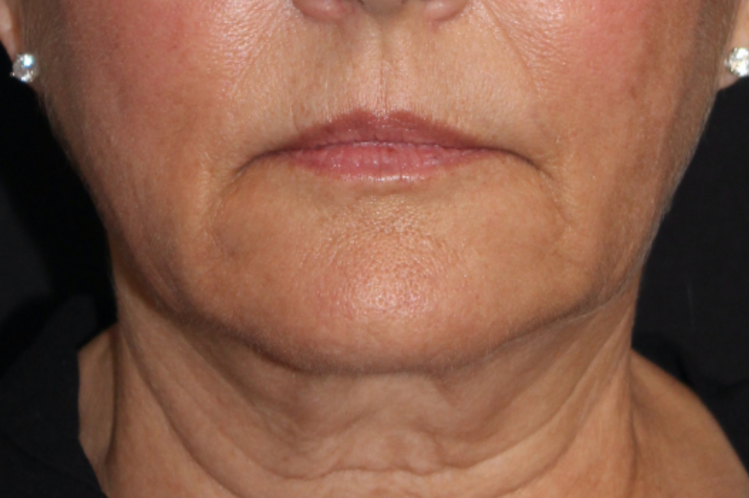 Patient 102 Before Image