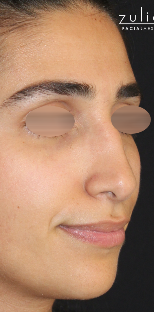 Patient #175 Before Image