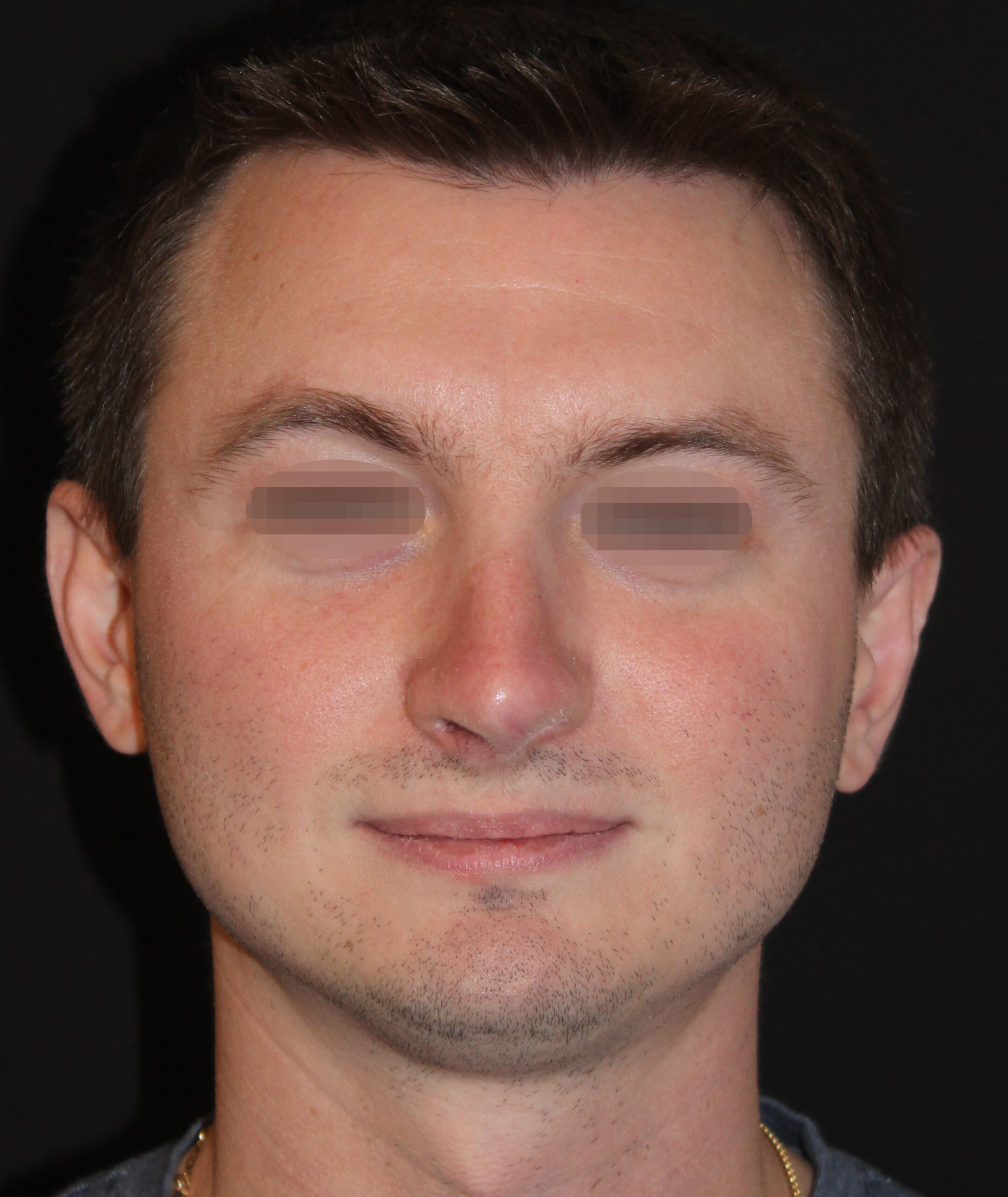 Patient 98 After Image