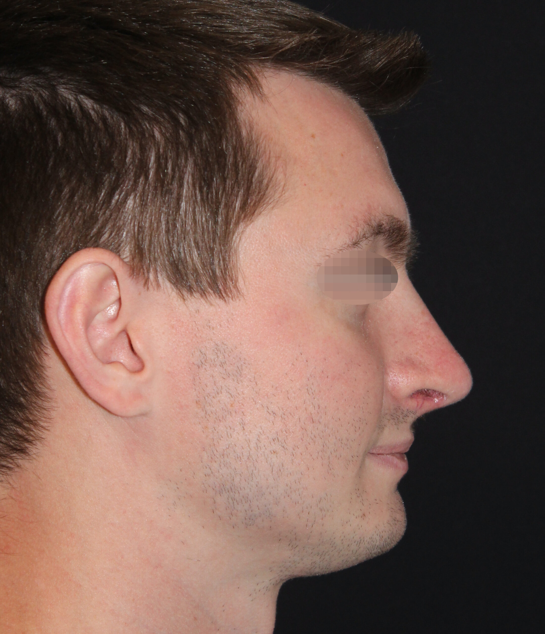 Patient 98 After Image