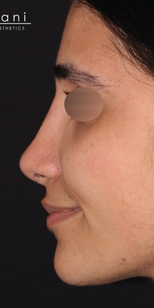 Patient #175 After Image