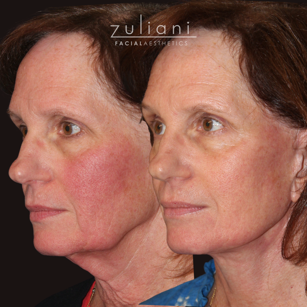 Patient #185 Marge Image