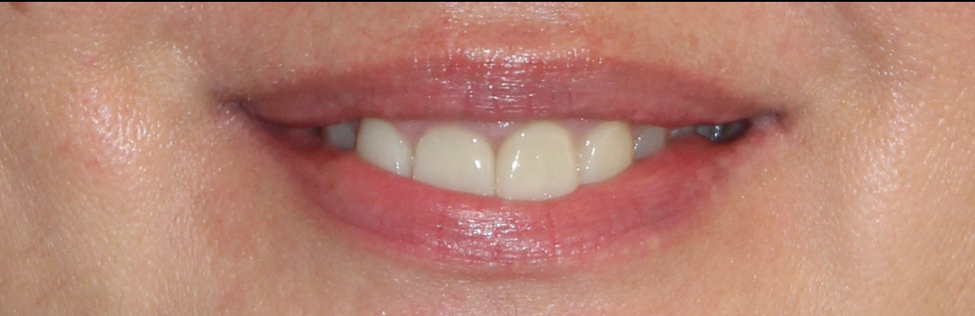 Patient #144 After Image