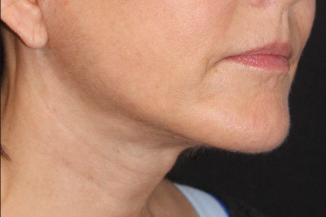 Patient 102 After Image