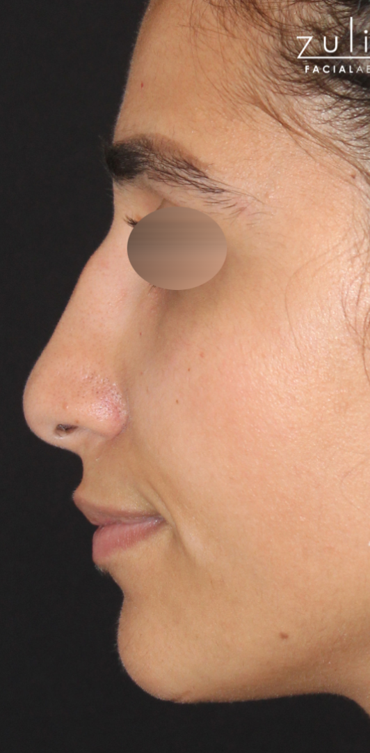 Patient #175 Before Image