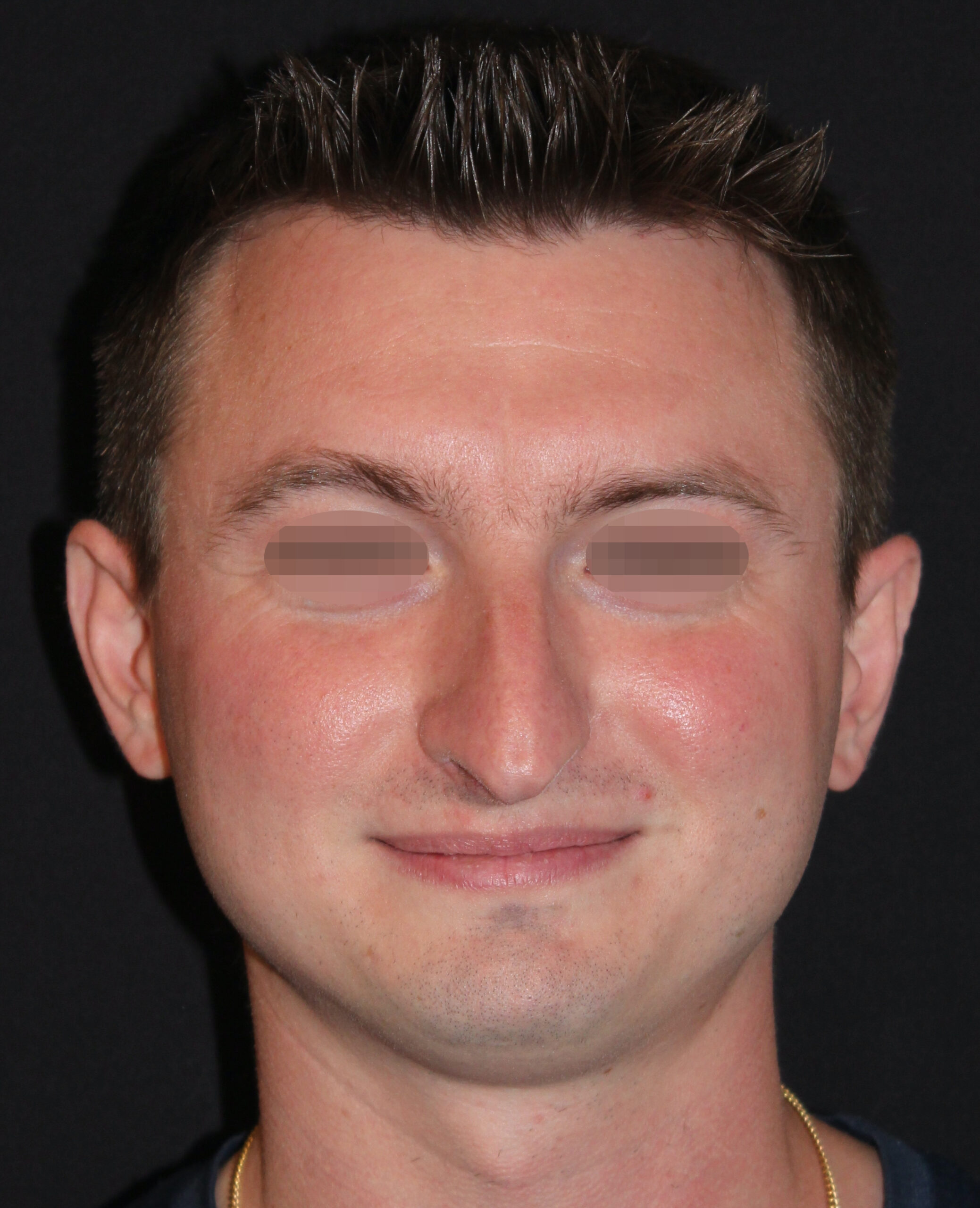 Patient 98 Before Image