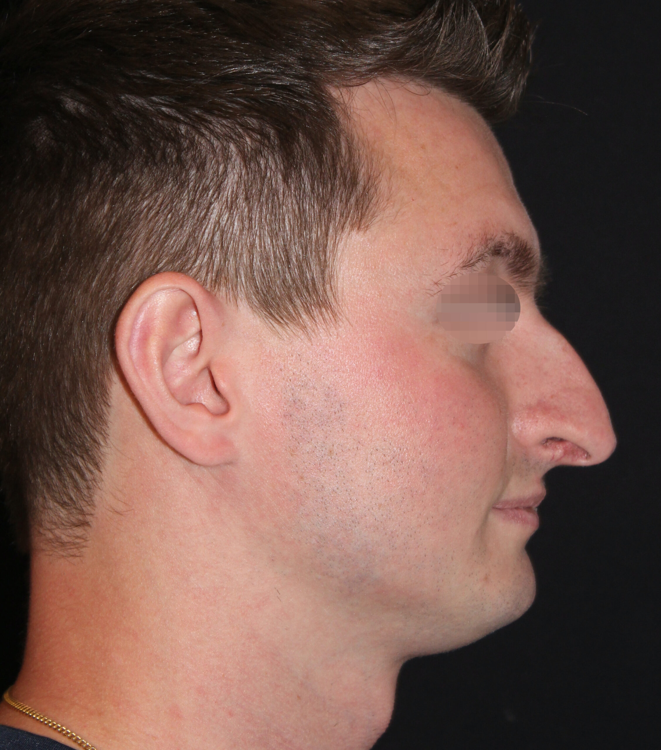 Patient 98 Before Image