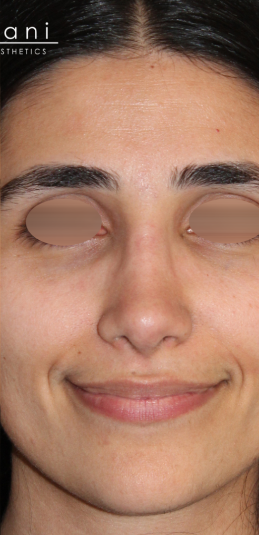 Patient #175 After Image