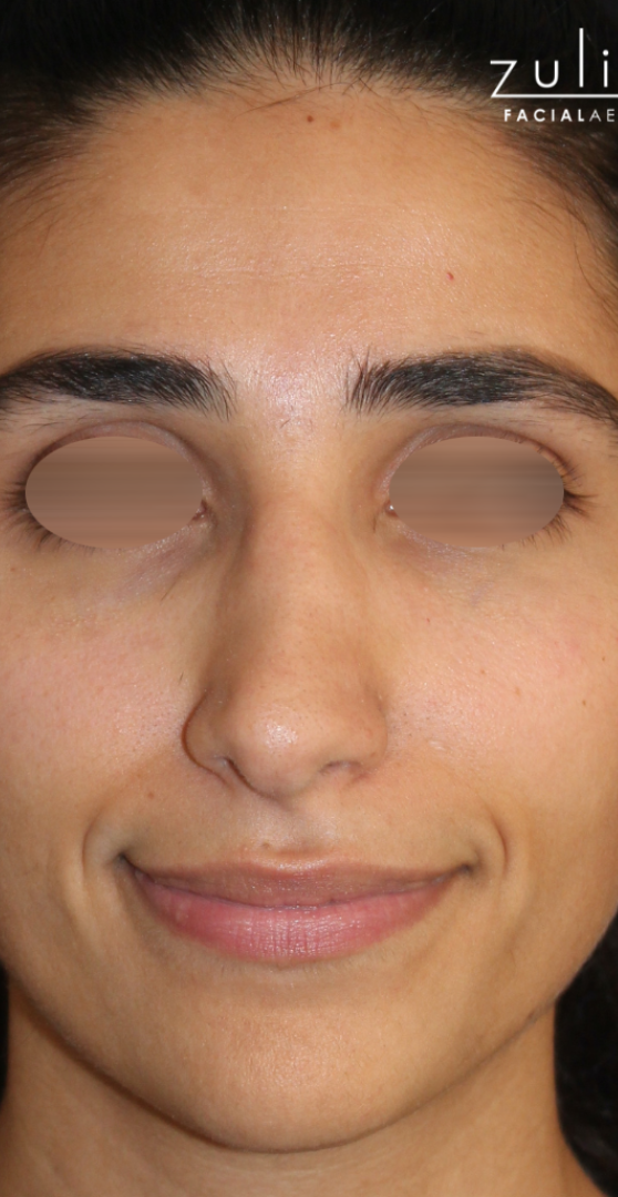 Patient #175 Before Image