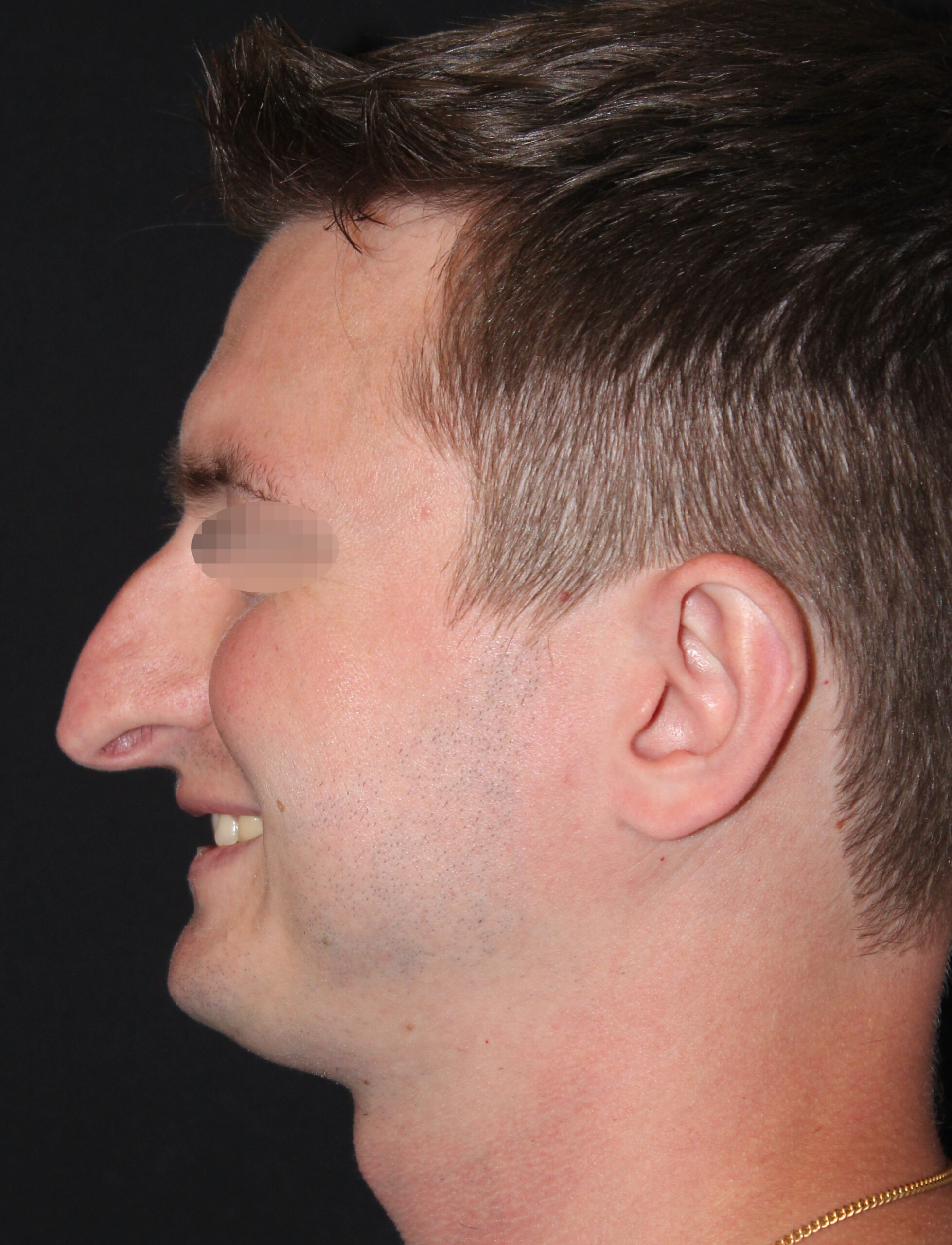 Patient 98 Before Image