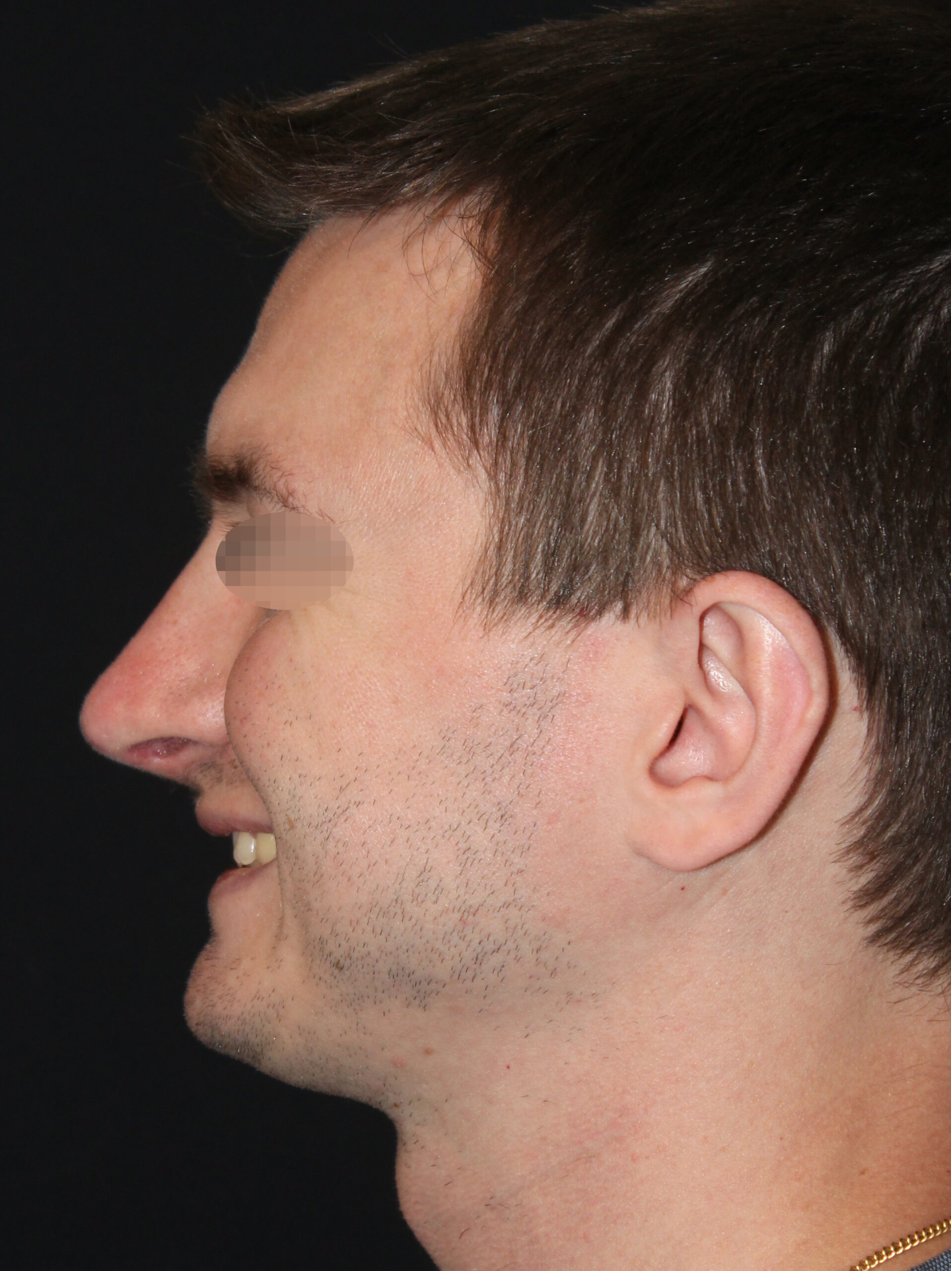 Patient 98 After Image