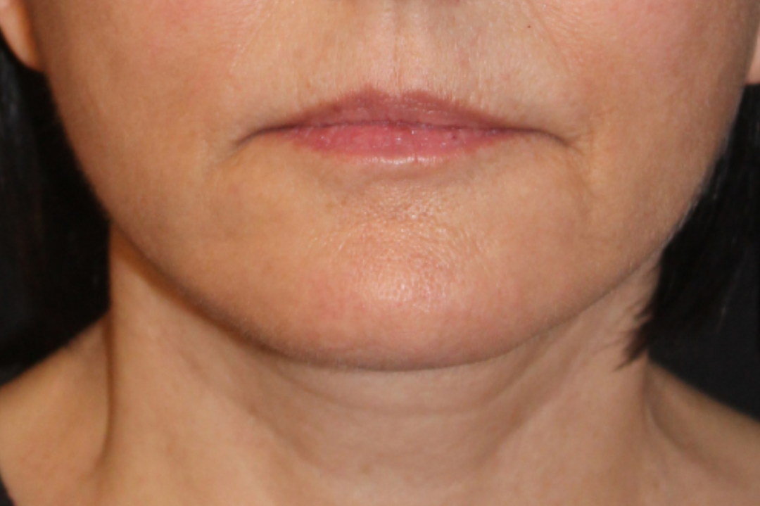 Patient 102 After Image