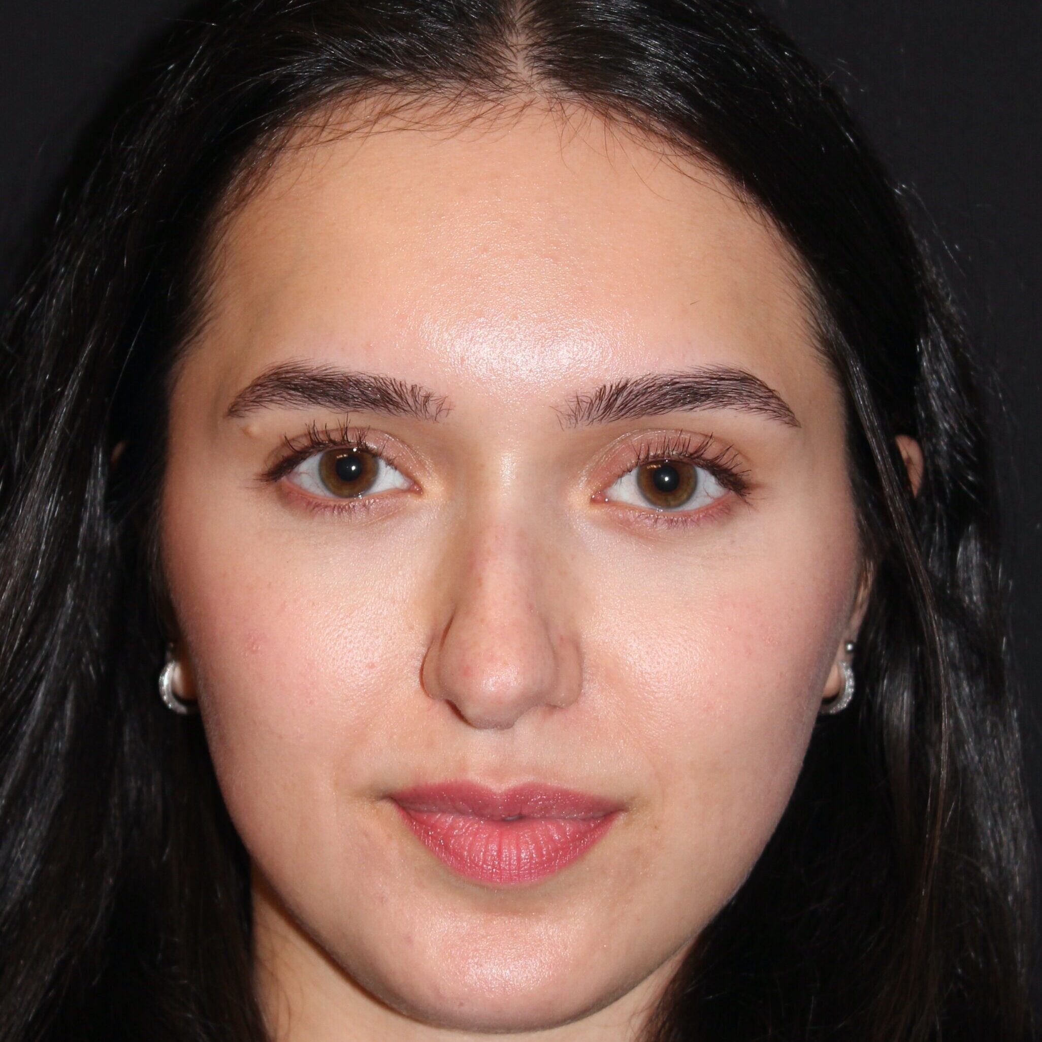 Patient #171 Before Image