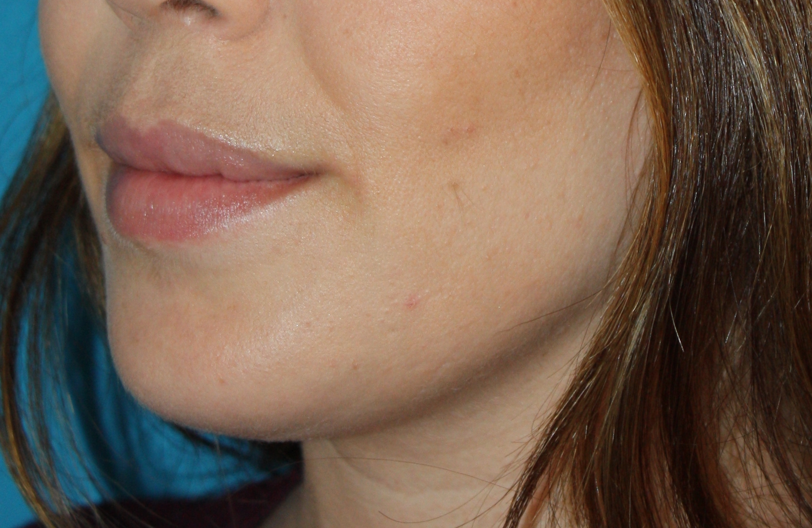 Patient 46 After Image