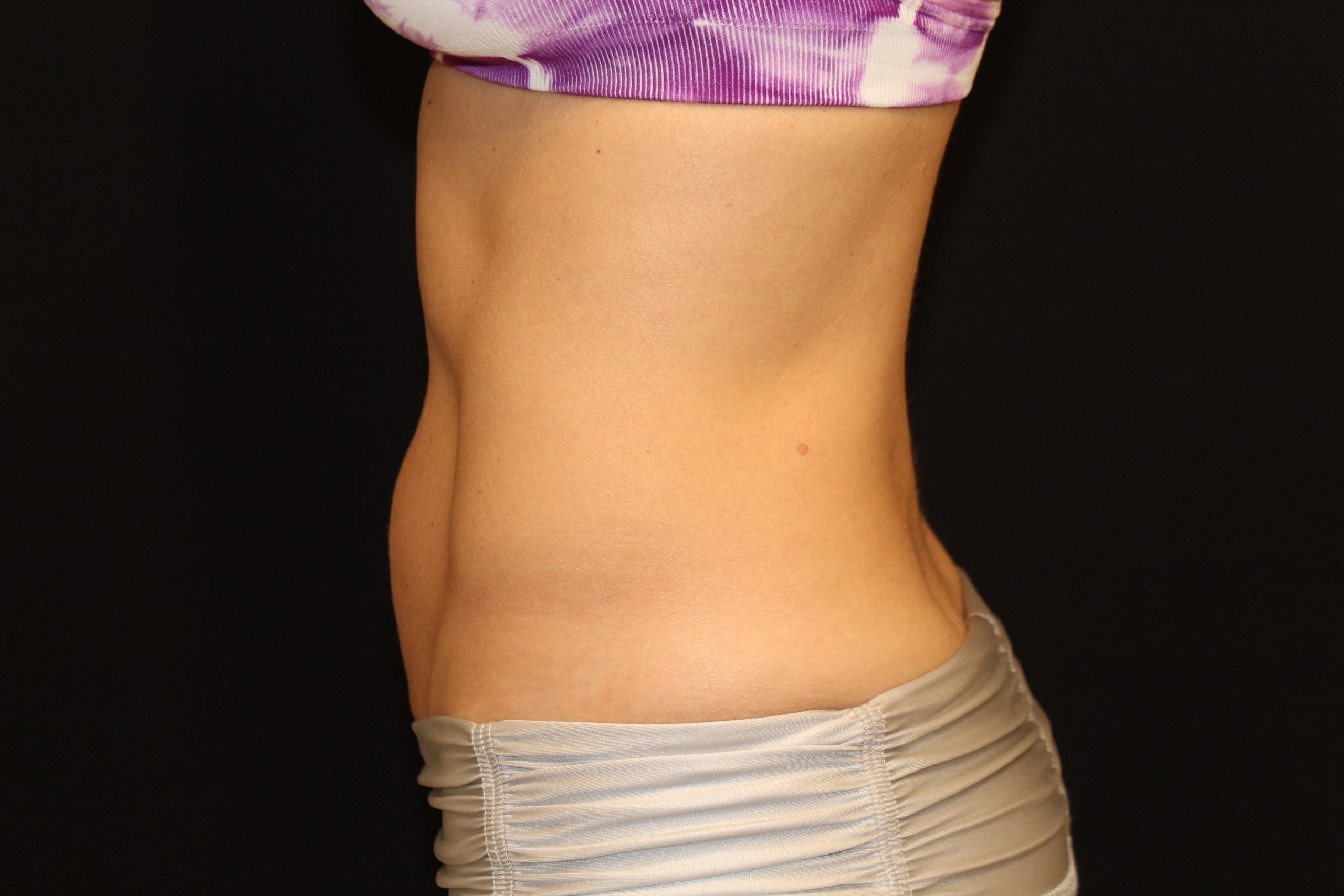 Patient 42 After Image