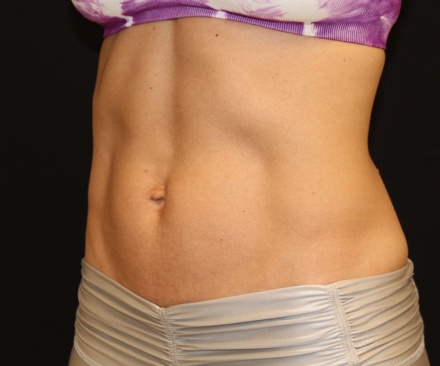 Patient 42 After Image