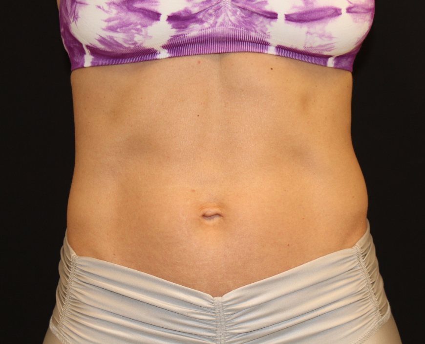 Patient 42 After Image