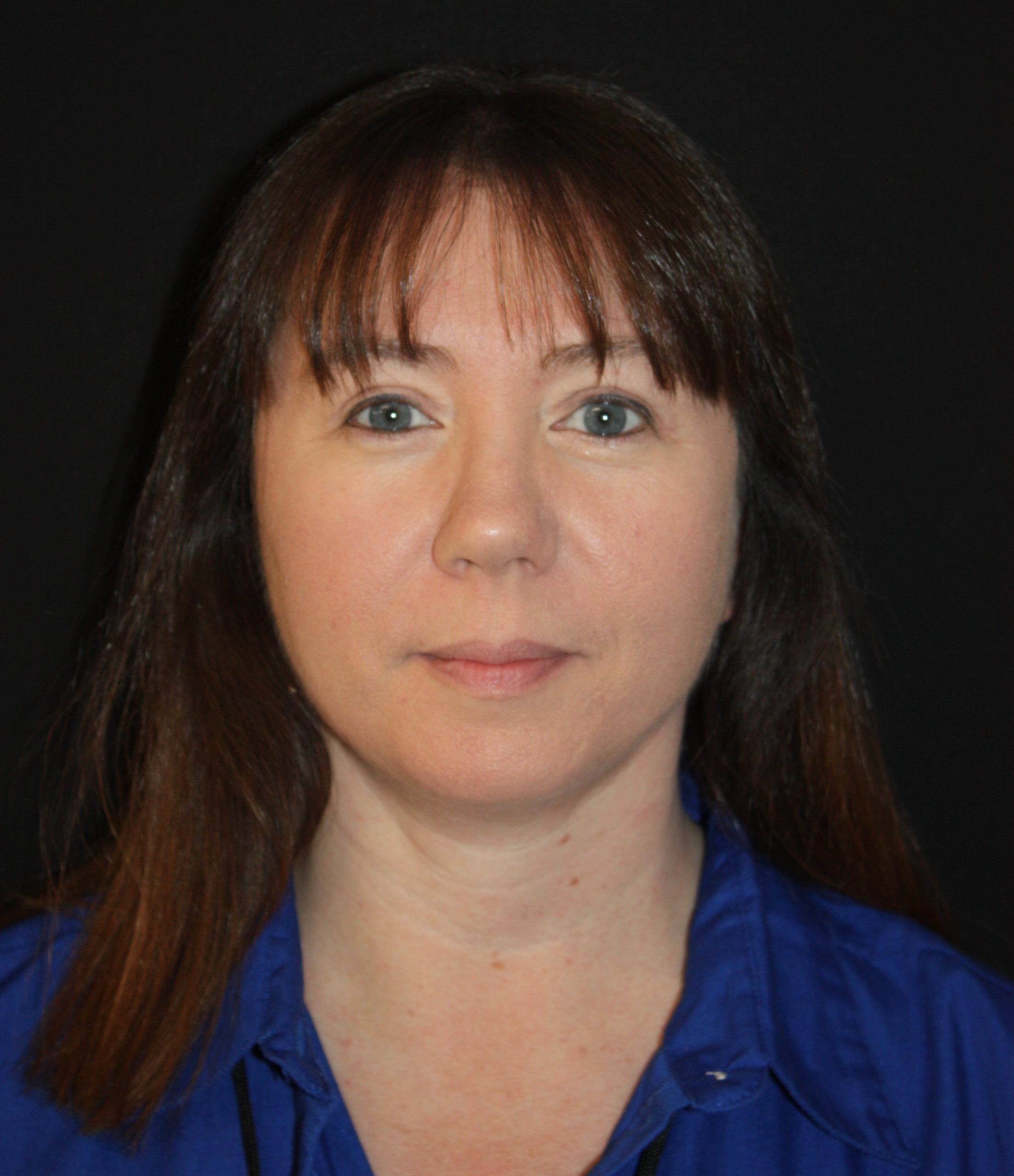 Patient 55 After Image