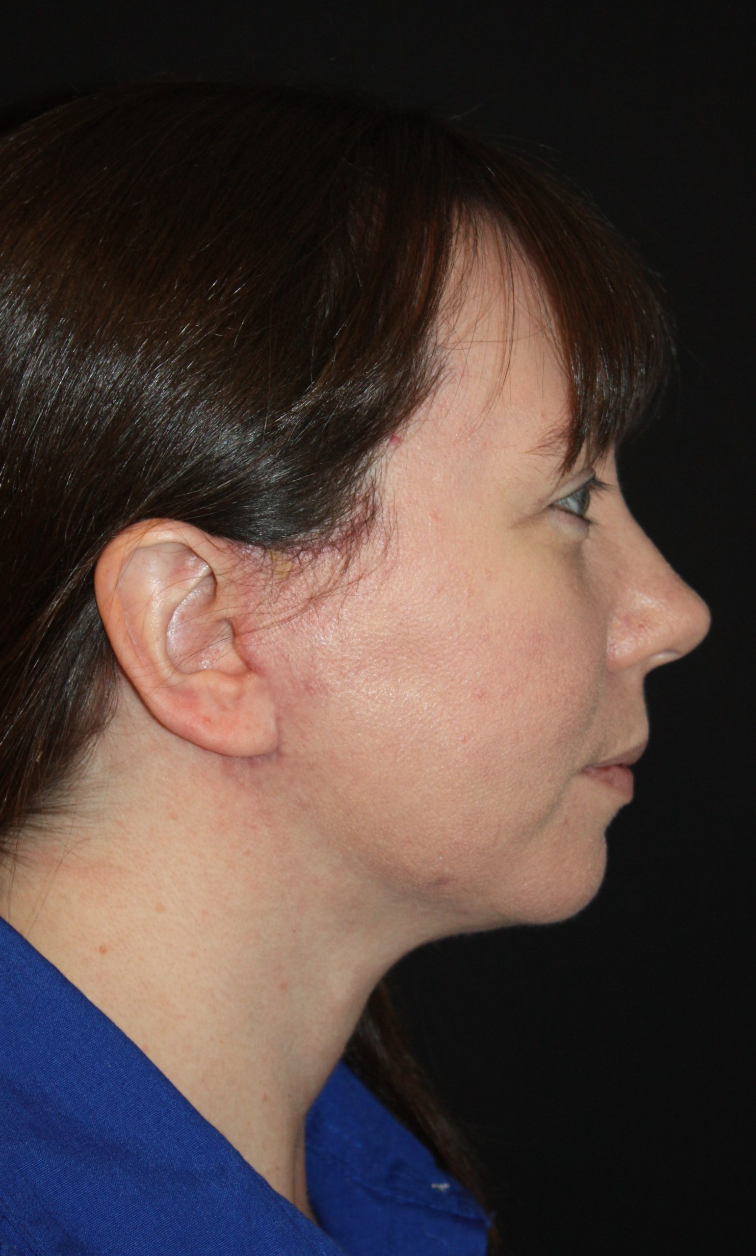 Patient 55 After Image