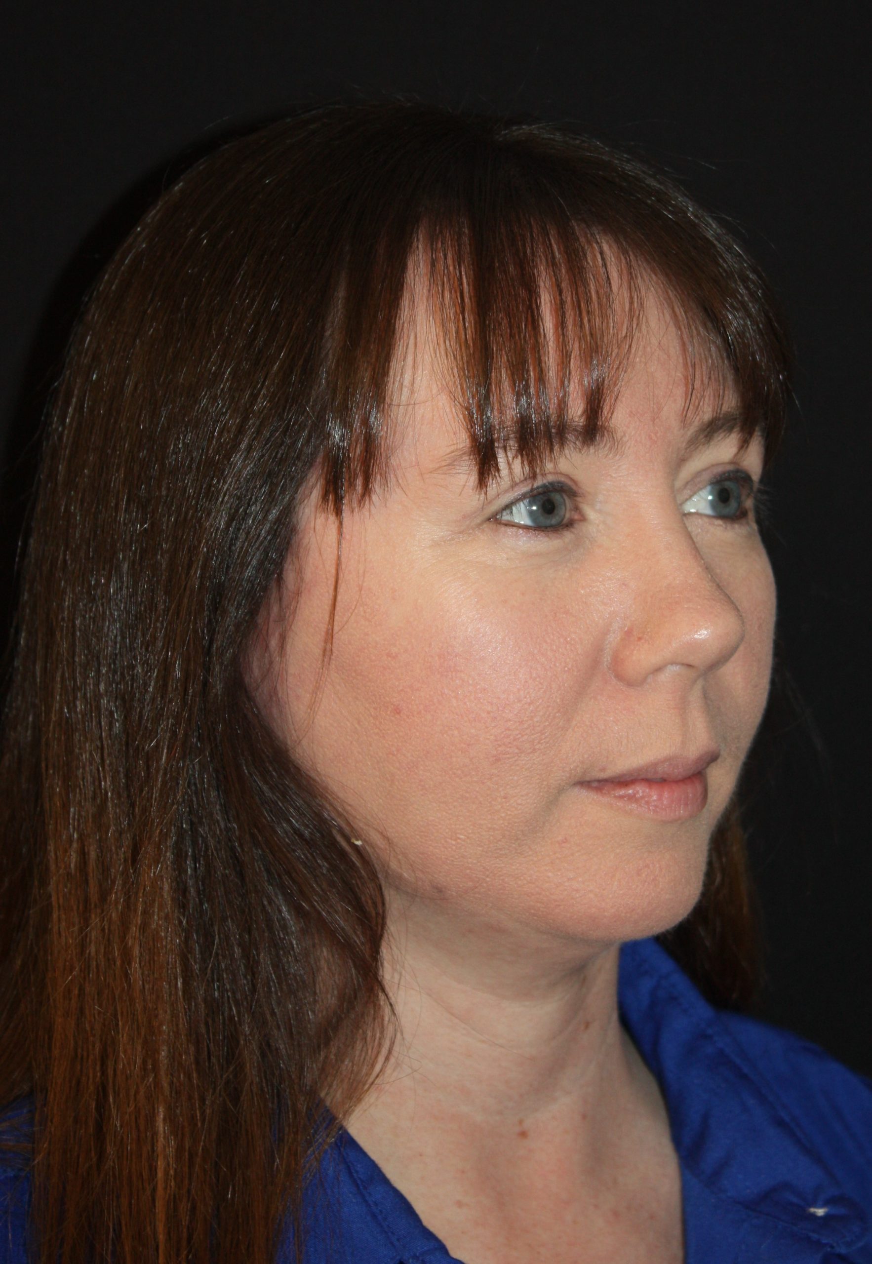 Patient 55 After Image