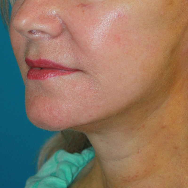 Patient 56 After Image