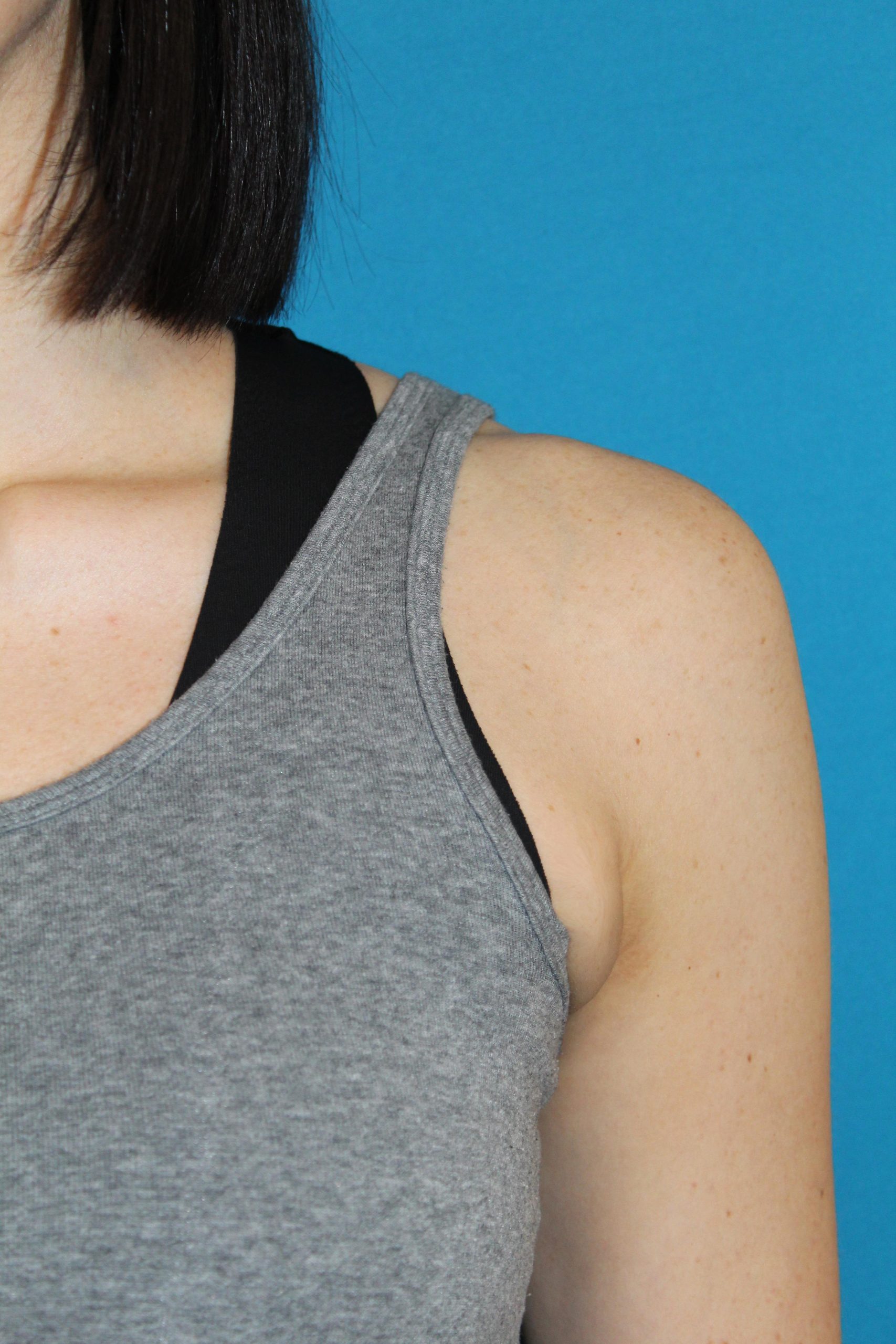 Patient 52 After Image