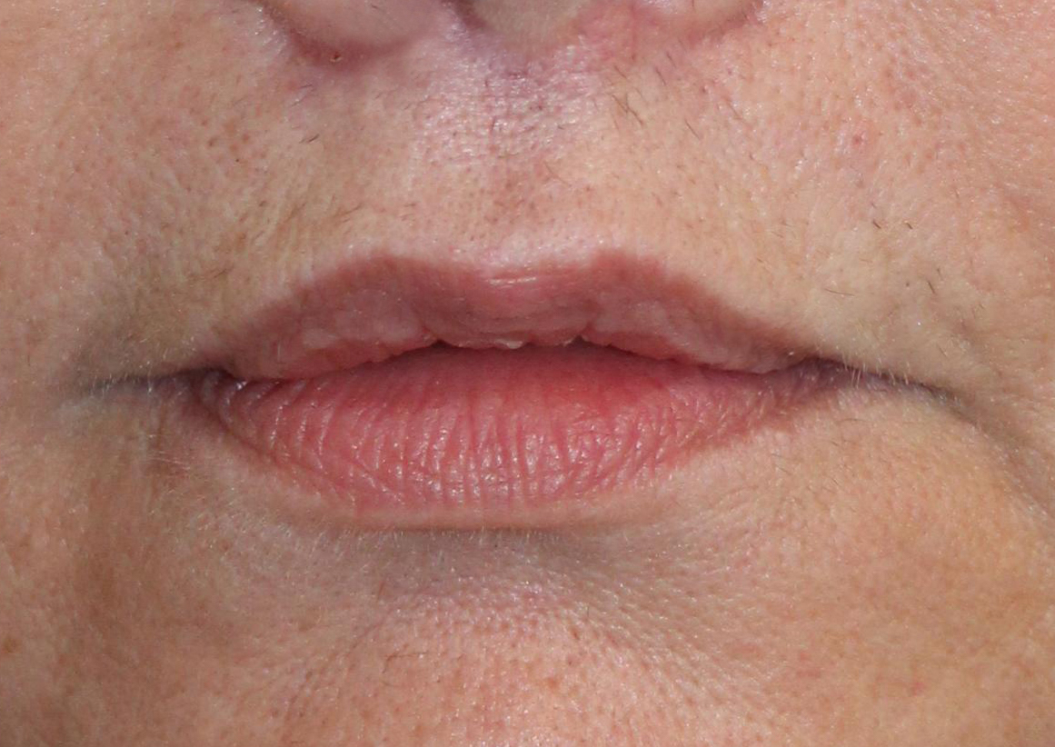 Patient 41 After Image