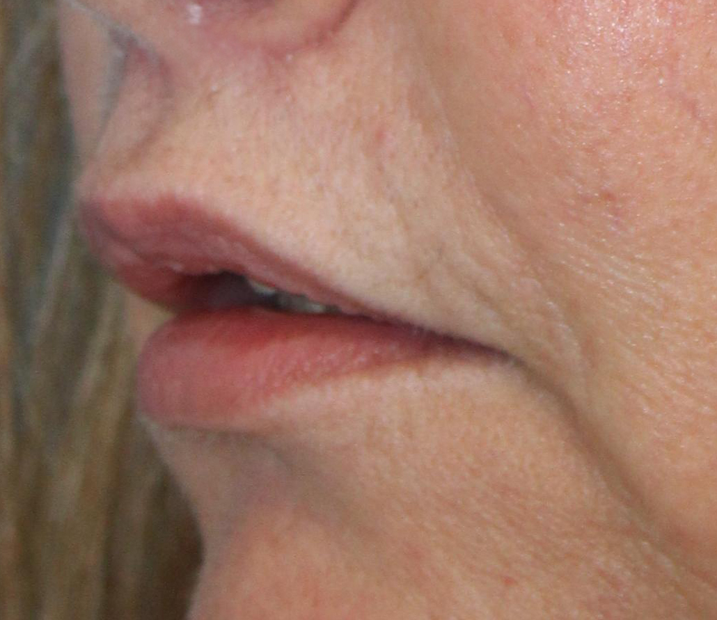 Patient 41 After Image