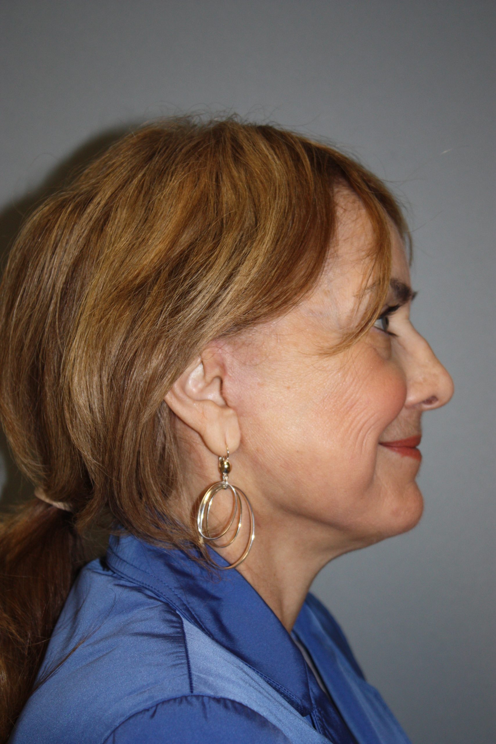 Patient 50 After Image