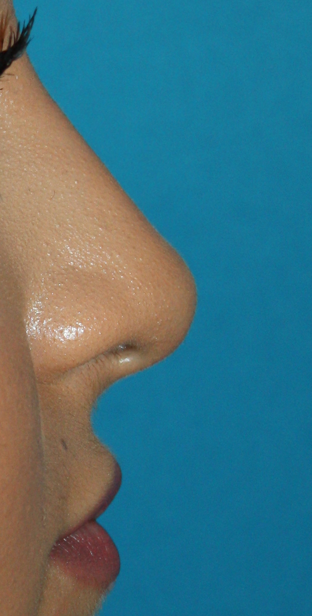 Patient 38 After Image