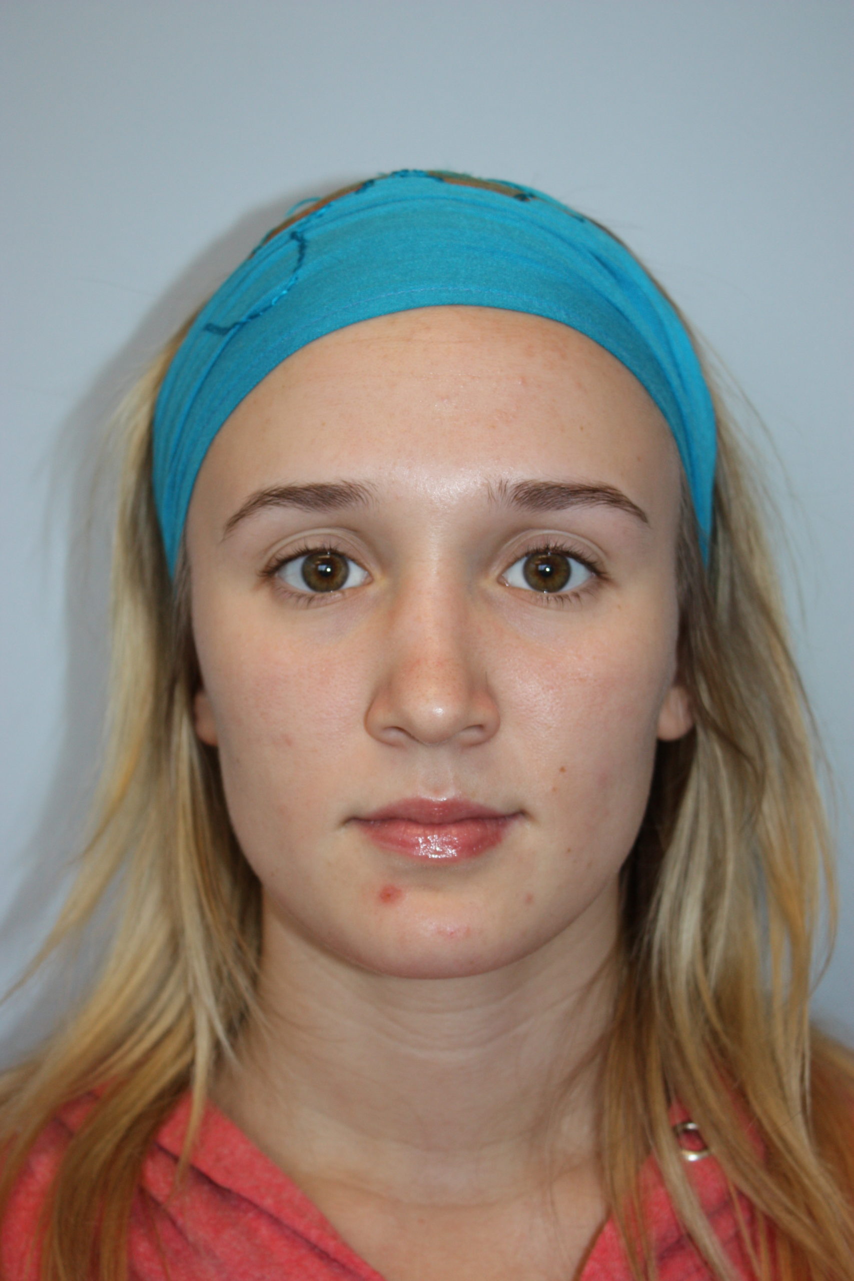 Patient 51 After Image