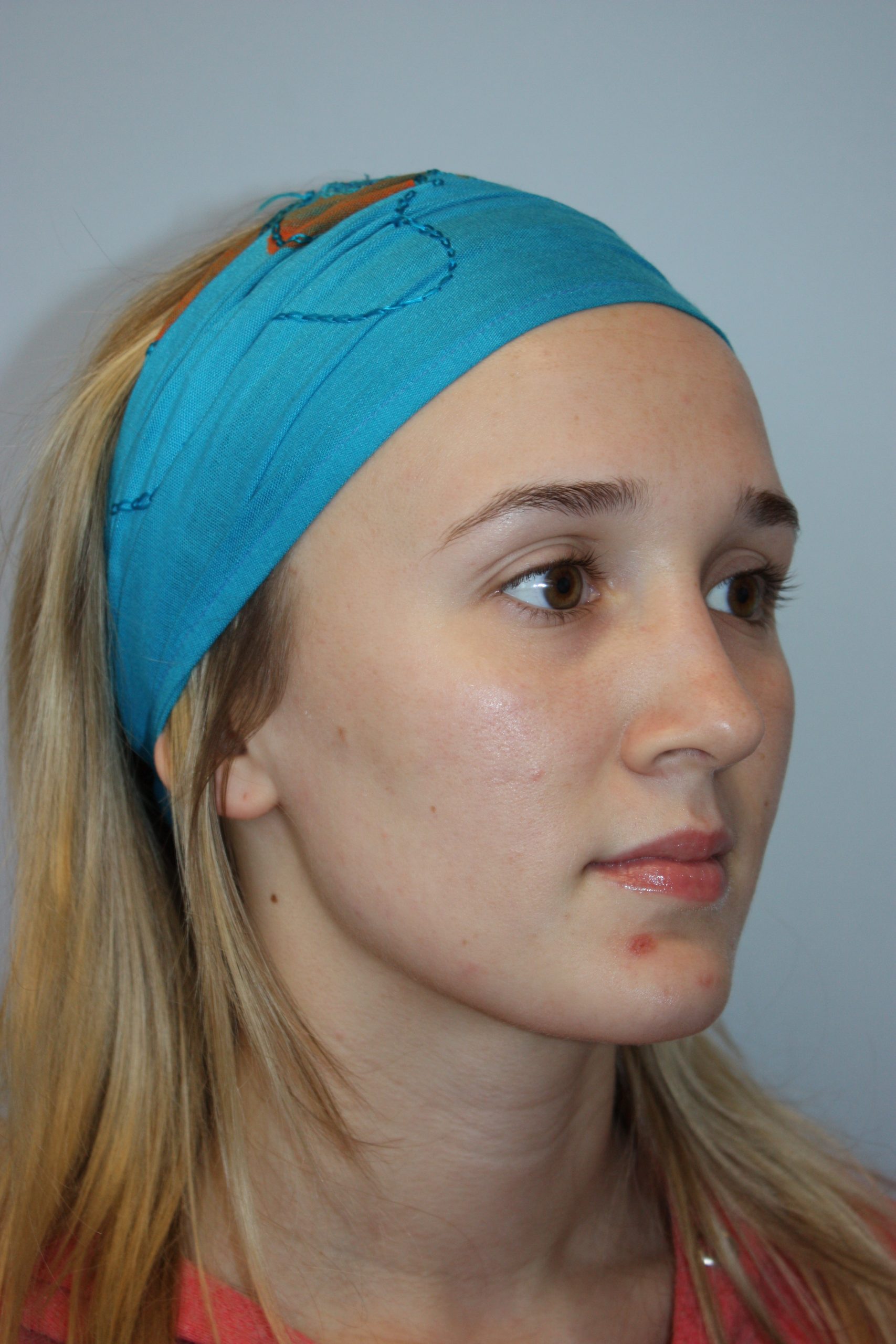 Patient 51 After Image