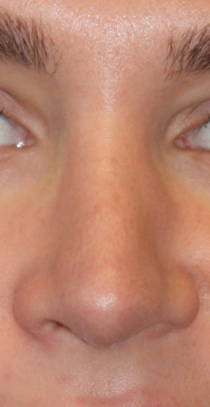 Patient 39 After Image