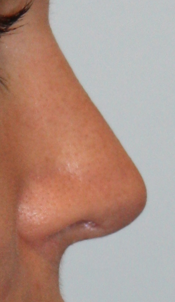 Patient 39 After Image