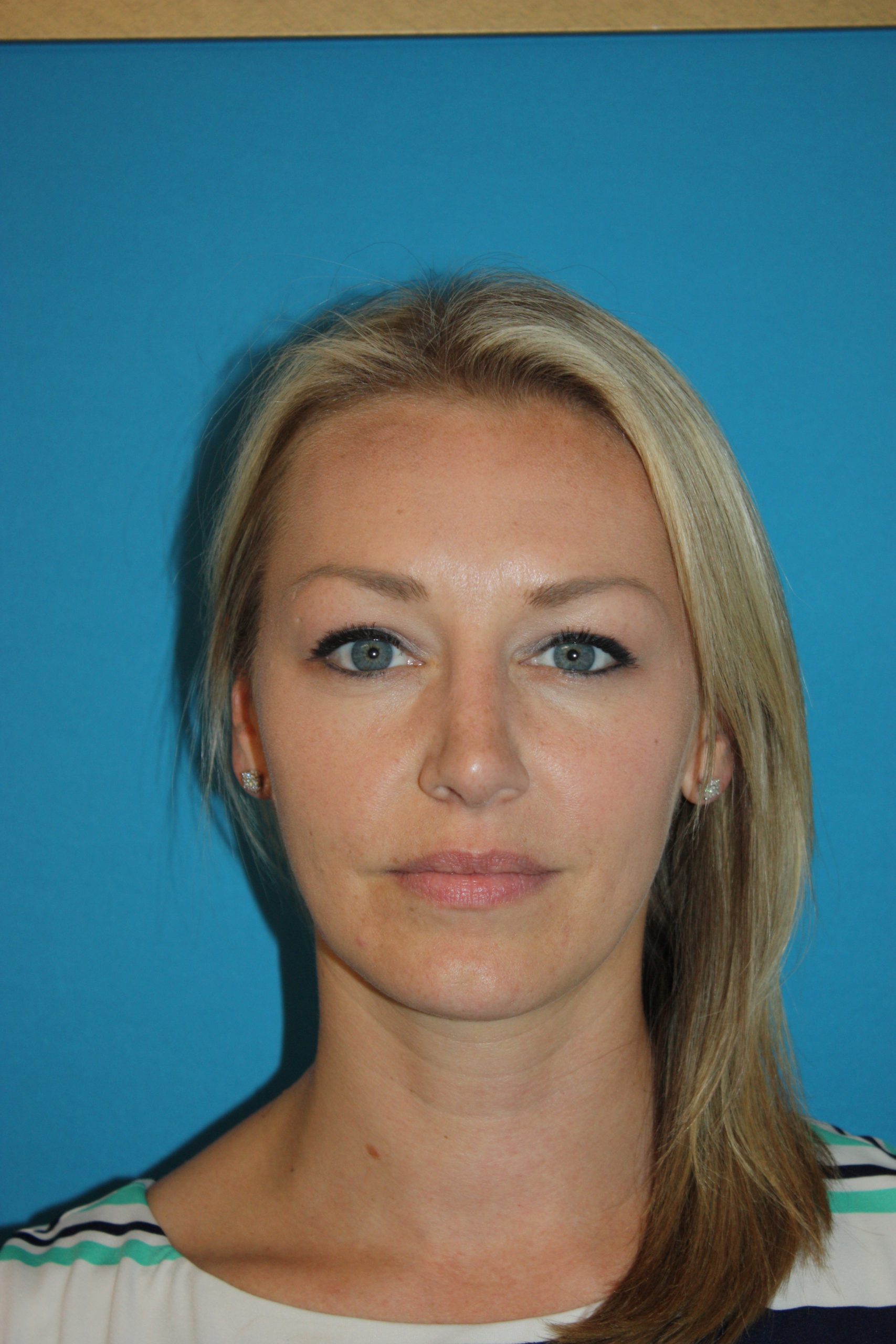 Patient 44 After Image