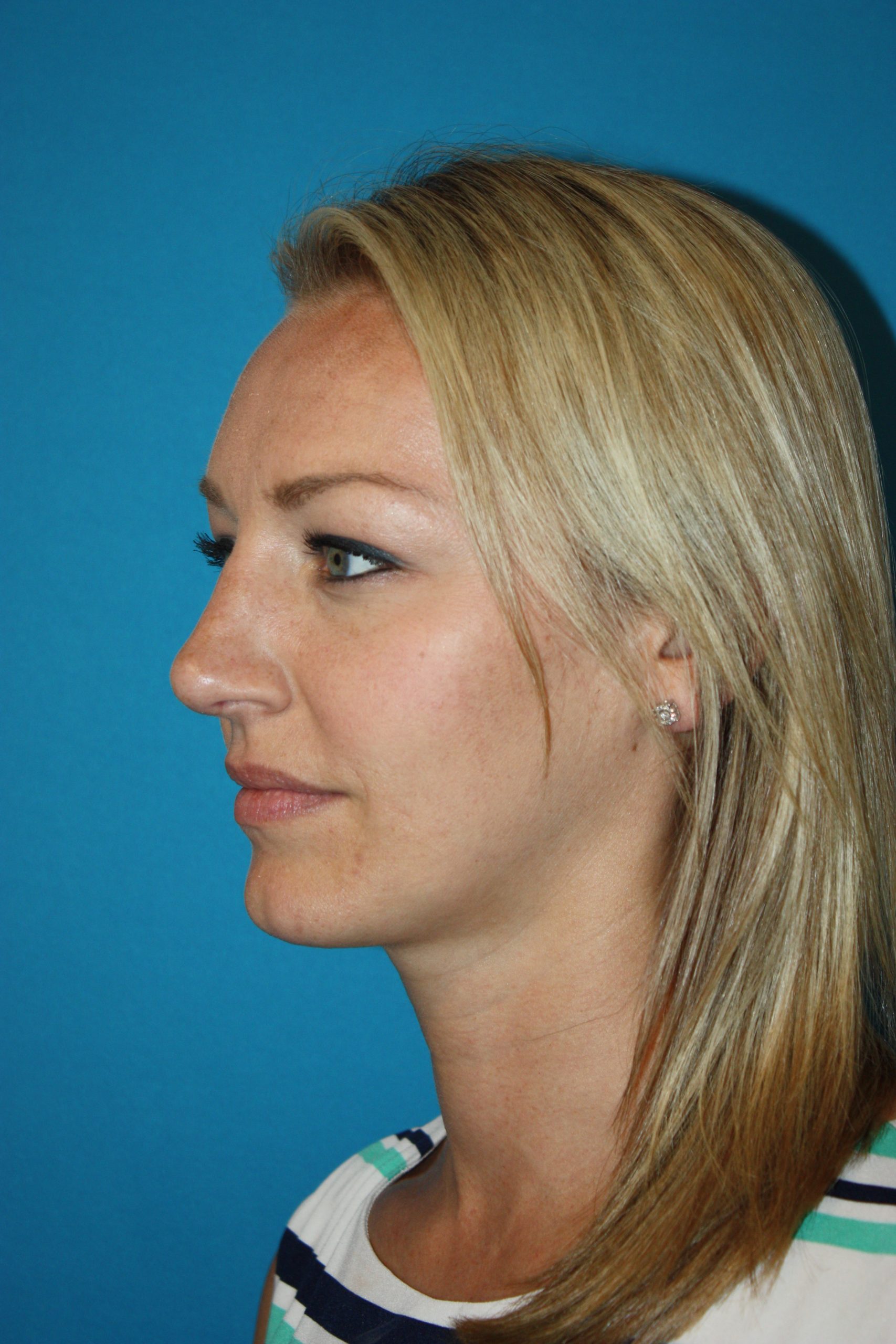 Patient 44 After Image