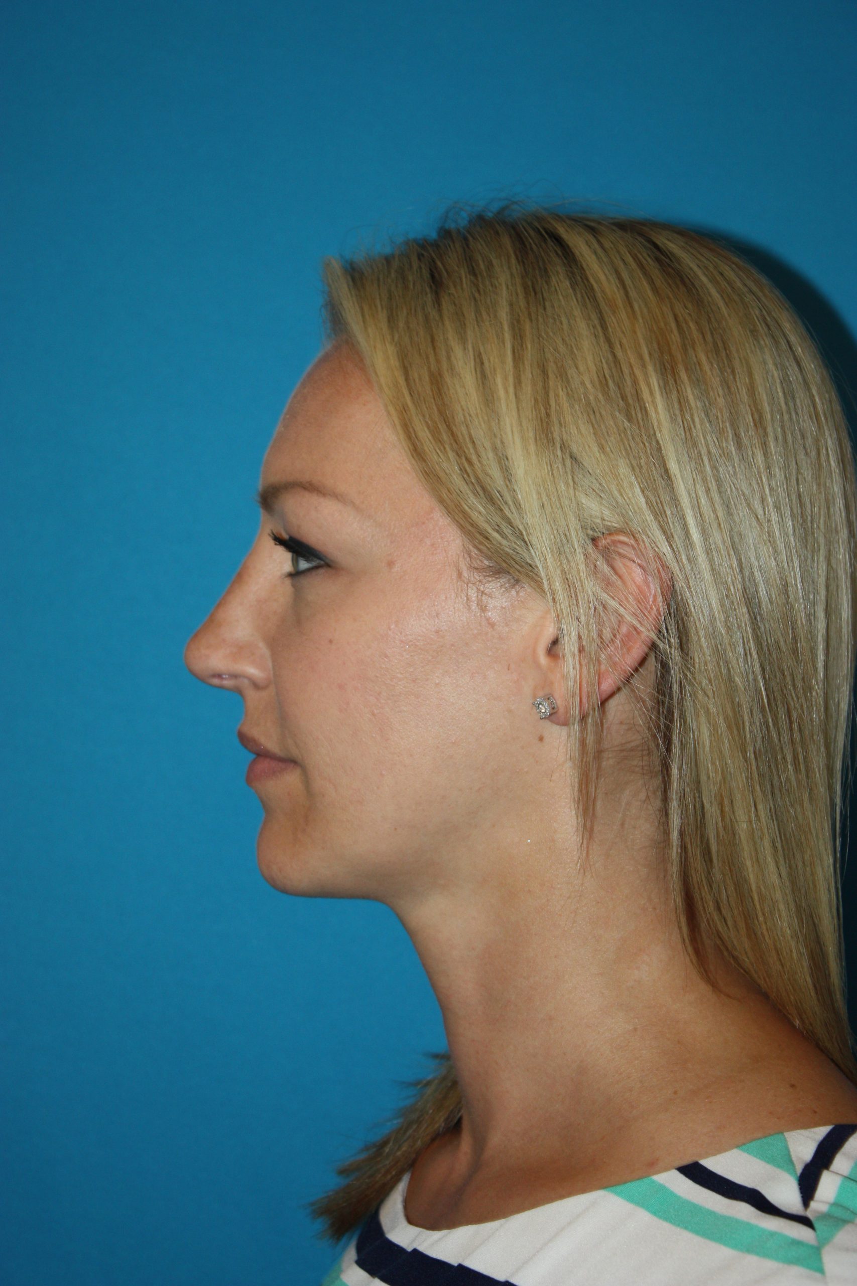 Patient 44 After Image