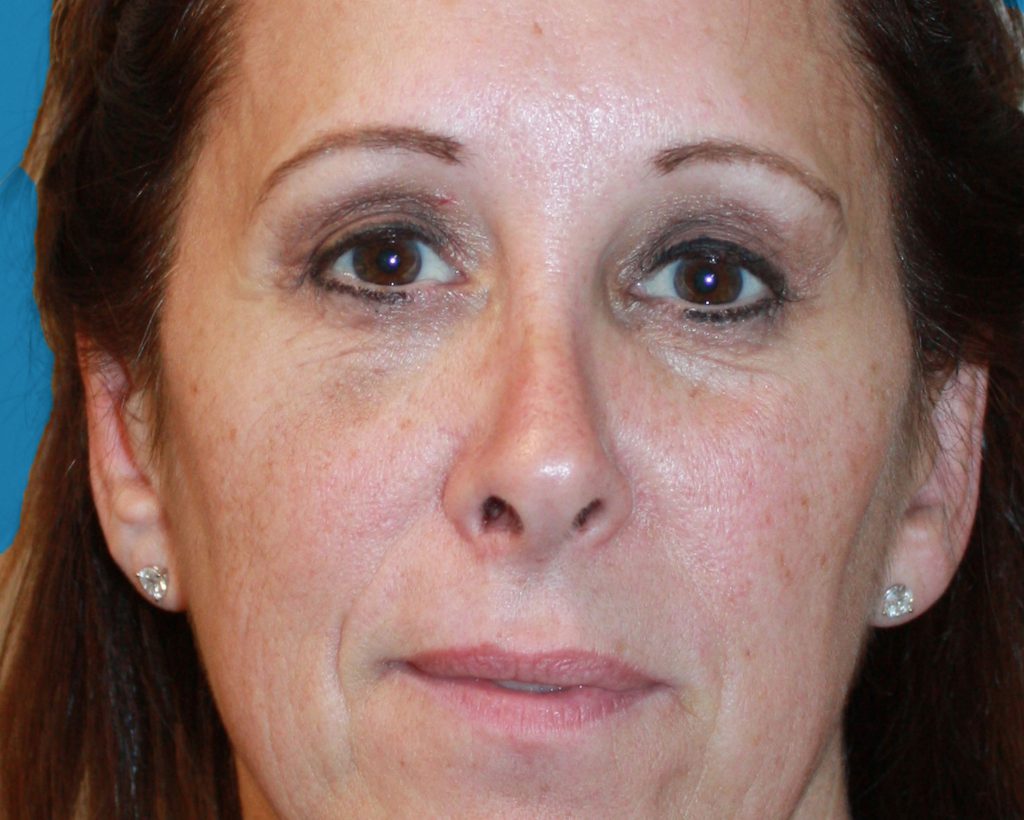 Patient 32 After Image